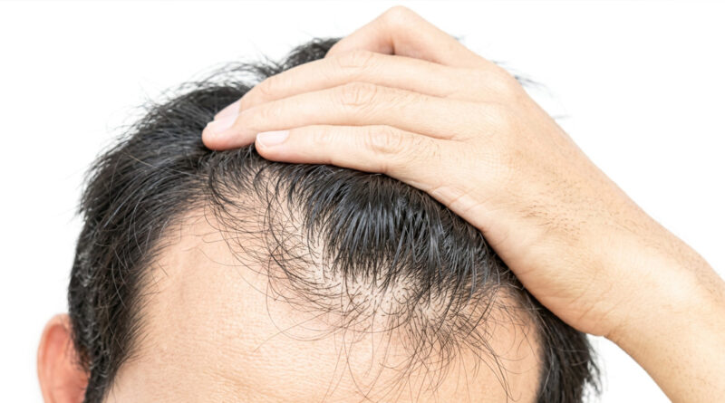 **କେଶ ଝଡ଼ିବା ରୋକିବା ପାଇଁ କିଛି ଟିପ୍ସ** means: **"Some tips to prevent hair fall"** 💇♀️🌿 Or more naturally: **"Tips to reduce and prevent hair loss"** ✨💆♂️🧴