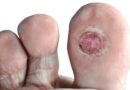 Ignoring Painless Foot Ulcers Could Lead to Amputation in Diabetics: Doctors