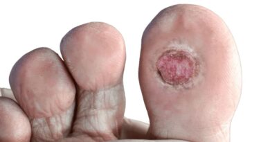 Ignoring Painless Foot Ulcers Could Lead to Amputation in Diabetics: Doctors