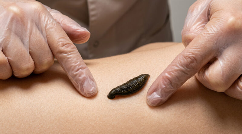 **Demand for ‘Leech Therapy’ is increasing; leeches are giving a new lease of life, and diseases are being cured for just ₹50.**
